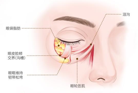衰老的标志去除眼袋焕发青春光彩米乐体育app网站眼袋不是自然(图1)